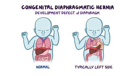 Congenital diaphragmatic hernia: Nursing - Biblioteca de Osmosis