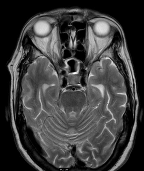 Early Cavernous Sinus Thrombosis-Gd MRI - Sumer's Radiology Blog