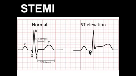 Stemi Ecg Vs Normal | Hot Sex Picture