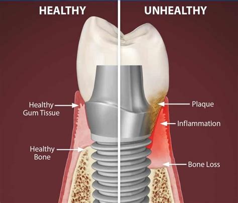 Dental Implant Failure: Reasons & Prevention | Dantkriti Dental Clinic