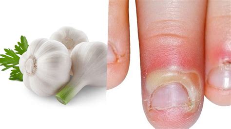 PERFECT GARLIC CLOVES REMEDY FOR WHITLOW - Health GadgetsNG