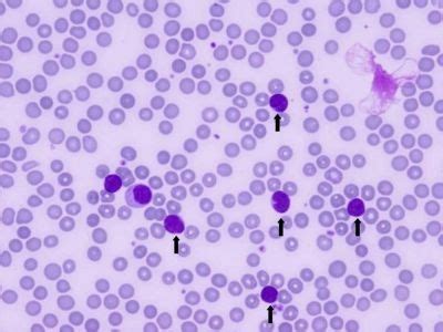 Peripheral blood involvement by follicular lymphoma