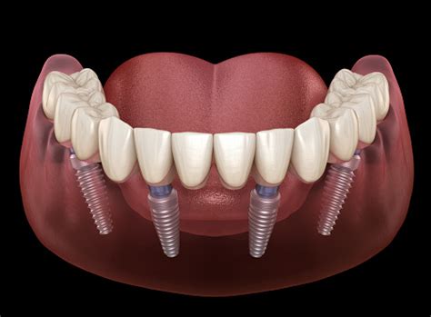 Photo libre de droit de Prothèse Mandibulaire All On 4 Système Soutenu Par Des Implants ...