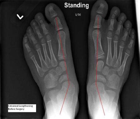 Calcaneal (Lateral Column) Lengthening