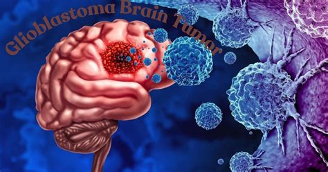 Glioblastoma Brain Tumor: Understand symptoms, stages, treatment & More