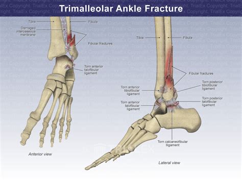 Trimalleolar Ankle Fracture - TrialQuest Inc.