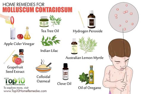 Home Remedies for Molluscum Contagiosum | Top 10 Home Remedies