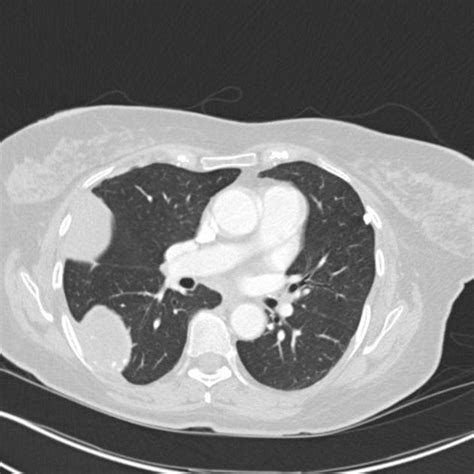 Mesothelioma Ct Scan - Example Of A Patient With Right Sided Mpm ...