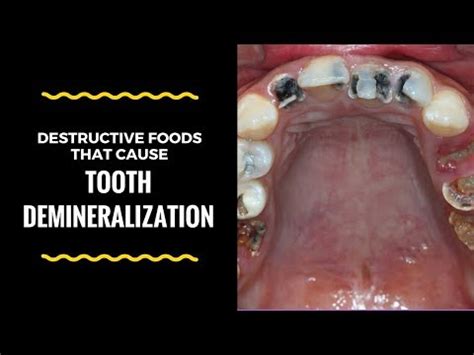 What is Tooth Demineralization