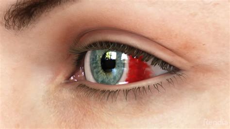 Eye Bleeding: What You Need to Know - SightMD