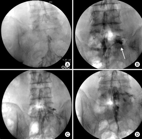 A novel balloon-inflatable catheter for percutaneous epidural ...