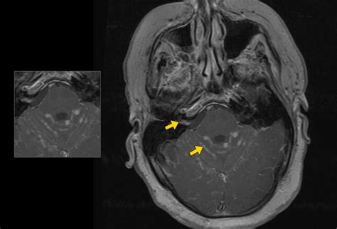 Bell Palsy: A Clinical Diagnosis with a Management Challenge