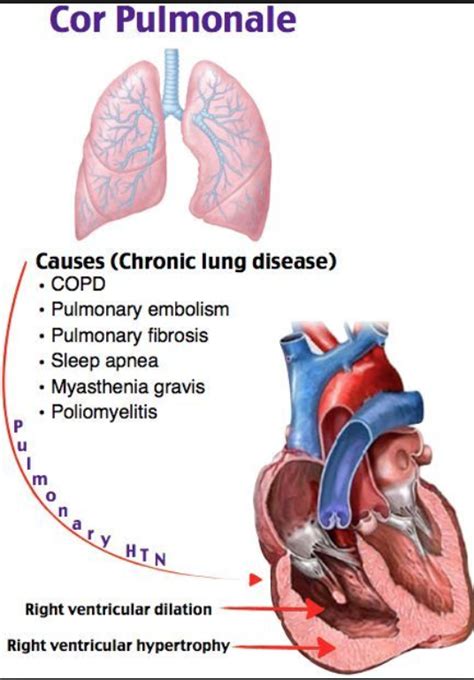 22. Cor pulmonale chronicum – greek.doctor