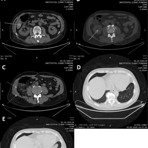 A, B -abdominal CT-scan showing thickened aspect of the renal fascia ...