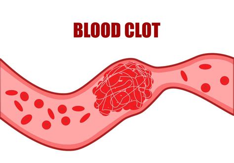 - American Blood Clot Association