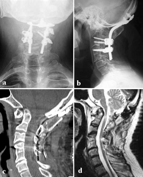 Surgical treatment of Klippel–Feil syndrome with basilar invagination | SpringerLink