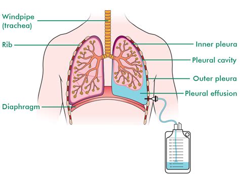 Learn About Pleural Effusion Drainage Drainage Of A Pleural Effusion | The Best Porn Website