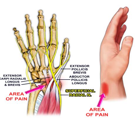 Extensor Carpi Radialis brevis: Review of Anatomy and Clinical Significance to Orthopedics ...