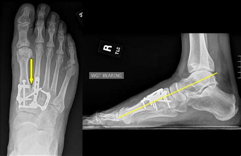 Midfoot Arthritis - Dr Hamish Curry | Foot & Ankle Surgeon