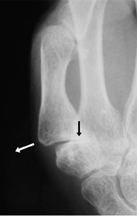 Figure 1 from Trapezial-metacarpal joint arthritis: radiographic correlation between first ...