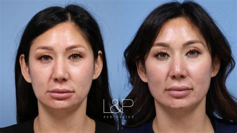 Facial Fillers Before and After Photo Gallery | Palo Alto & San Jose ...