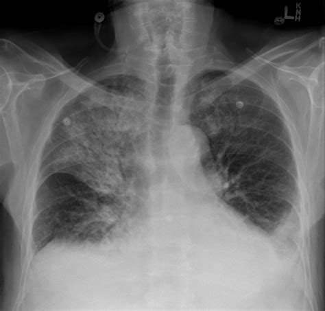 File:Figure 9.17A AP Chest x-ray, Pneumonia.jpg - NC Commons