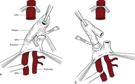 Basilic and Femoral Vein Transposition | Thoracic Key