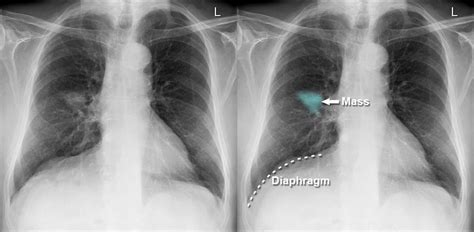 Chest X-ray - Lung cancer - Phrenic nerve palsy