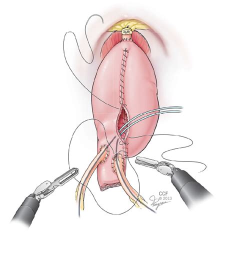 Robotic Radical Cystectomy Gaining Momentum as Alternative Open ...