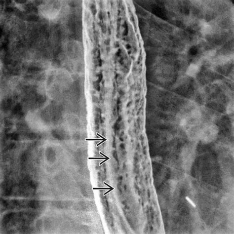 Esophageal Candidiasis Barium Swallow