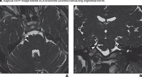 Trigeminal Nerve Mri Protocol