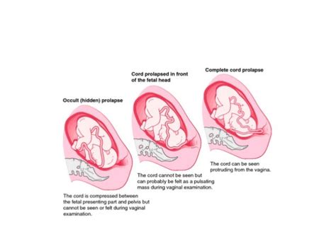 Cord prolapse