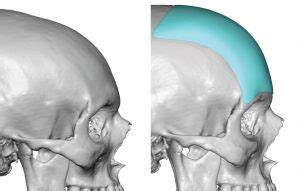 Can A Sloped Forehead be Fixed? - Plastic Surgeon | Dr. Barry L. Eppley, MD