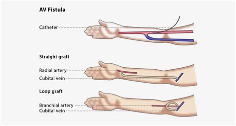 Dialysis Fistula Vs Graft