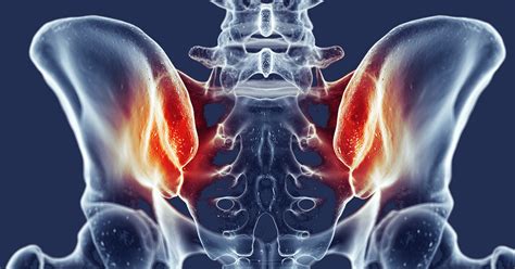 Sacroiliac Joint Dysfunction X Ray