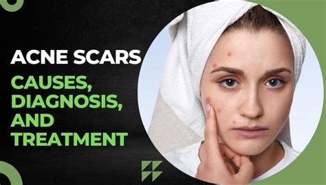 Acne Scars- Causes, Diagnosis, and Treatment