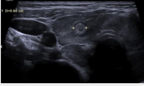 Ultrasound of thyroid. Heterogeneous thyroid echogenicity with... | Download Scientific Diagram