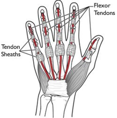 A Severed Flexor Tendon in the Pinky Finger | HealDove