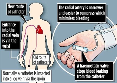 You can now get heart surgery through your WRIST!