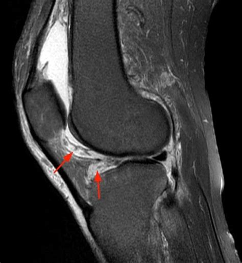 Image result for synovitis on MRI knee | Mri, Knee, Image