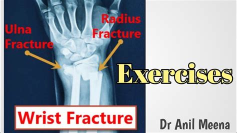 wrist fracture recovery exercises | wrist fracture physiotherapy ...