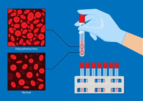 What Is Polycythemia Vera? | PV Reporter