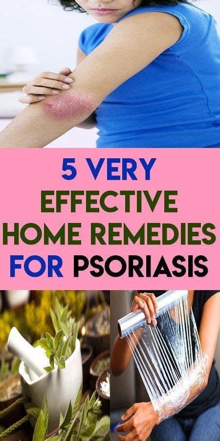 5 very effective home remedies for psoriasis - Keto Slim Reviews | Psoriasis remedies, Home ...