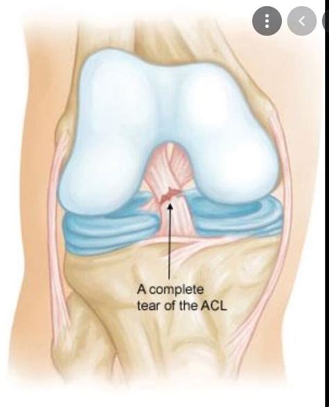 ACL Injuries: Signs, Symptoms And Causes - West Coast Orthopedics