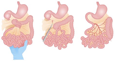 Malrotationsfehlbildung des Gastrointestinaltrakts - E-Learning mit Lecturio