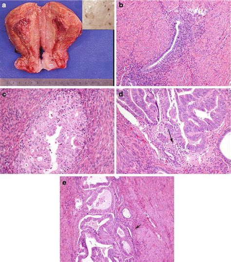 Diseases of the Myometrium | Basicmedical Key