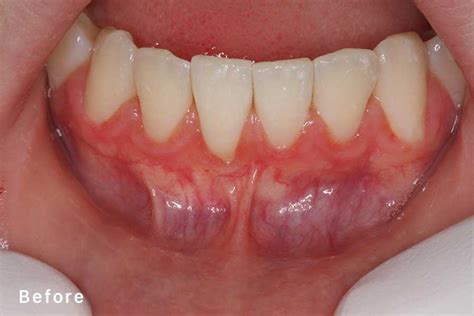 Frenectomy | Encinitas Perio | Daniel D Roberts DDS