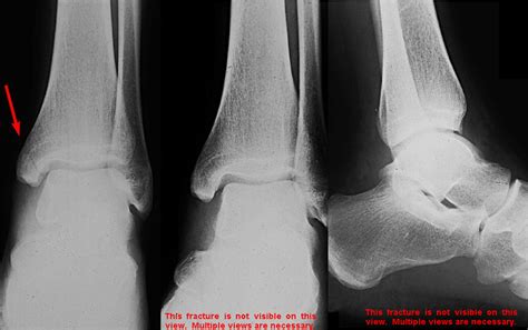 Isolated medial malleolus fracture