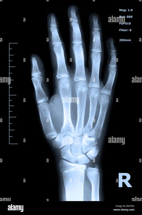 X ray of a human hand Stock Photo - Alamy