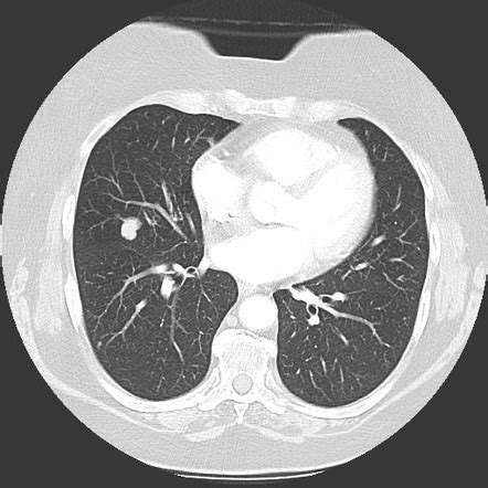 Carcinoid Tumor Lung Cancer